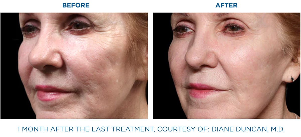 exion treatment navarre FL