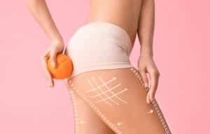 Cellulite on upper thighs, EMTONE cellulite reduction treatment Navarre, FL