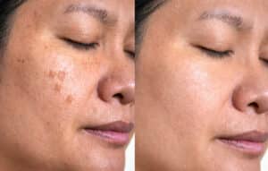 Woman with age spots, before and after Glacial Freeze